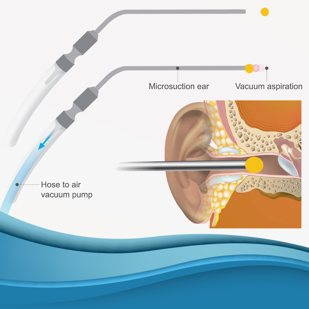 Ear wax removal with microsuction in Cleveland